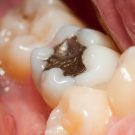 What Your Dentist Isn’t Telling You About Mercury